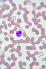 Neutrophil cell (white blood cell) in blood smear, analyze by microscope

