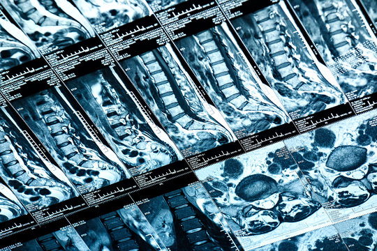 Magnetic resonance imaging of the human spine