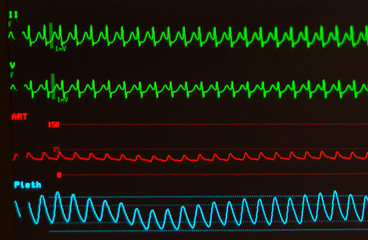 Monitor showing atrioventricular nodal reentrant tachycardia or AVNRT (green lines), arterial blood pressure (red line) and oxygen saturation (blue line) against a black background.