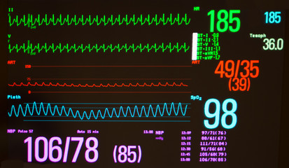 Monitor showing atrioventricular nodal reentrant tachycardia or AVNRT (green lines), arterial blood pressure (red line) and oxygen saturation (blue line) against a black background.