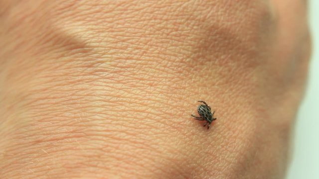 Dog Tick, Dermacentor variabilis,  Encephalitis, Ixodes scapularis on human skin