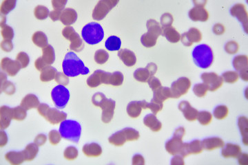 Naklejka na ściany i meble Leukemia cells in blood smear, analyze by microscope 