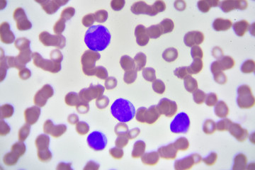 Naklejka na ściany i meble Leukemia cells in blood smear, analyze by microscope 