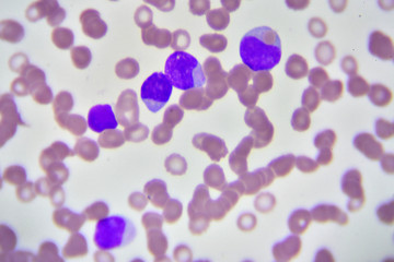 Leukemia cells in blood smear, analyze by microscope
