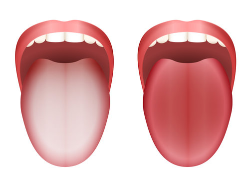 Coated white tongue and clean healthy tongue by comparison - isolated vector illustration on white background.