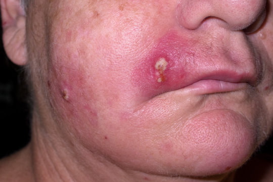 Mature woman with staph infection on face 4