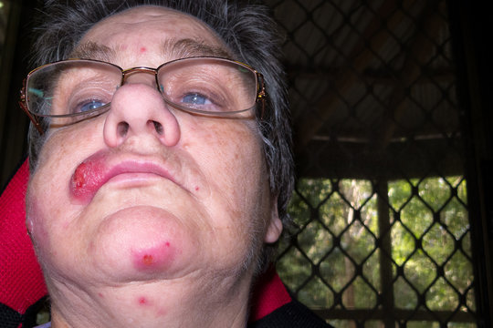 Mature woman with staph infection on face 7