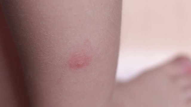 small child with a mosquito bite on his leg, close-up. Allergy to insect bites.