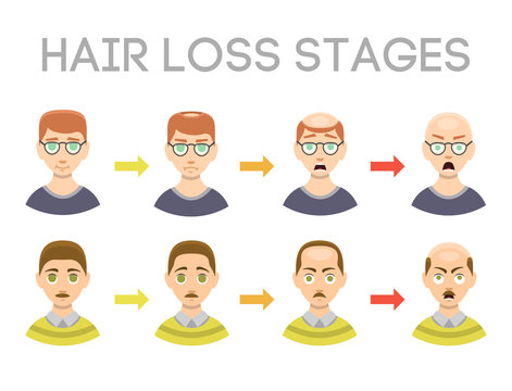 Information chart of hair loss stages types of baldness illustrated on male head vector.