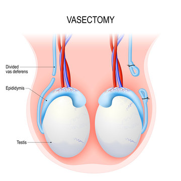 Vasectomy. Open-ended method and ligating (suturing).