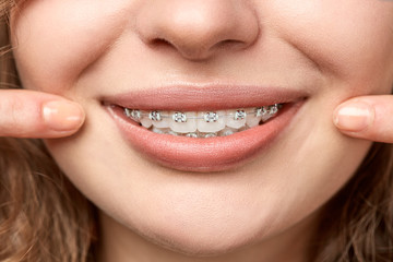 curly hair woman with brackets