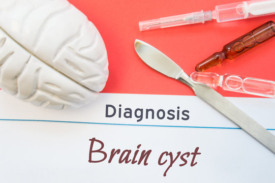 Brain figure, surgical scalpel, syringe and vials lying around title Diagnosis Brain Cyst. Concept photo for diagnosis, surgical and medicinal treatment of brain diseases Brain Cyst
