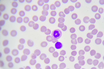 White blood cells in in blood smear, analyze by microscope
