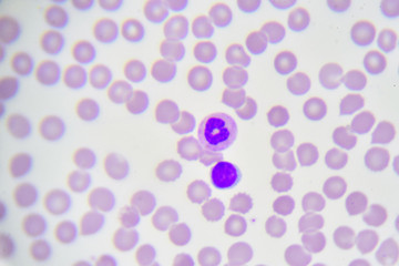 White blood cells in in blood smear, analyze by microscope
