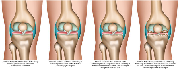 Kniearthrose, Stadien bei Arthrose im Knie, vektor illustration
