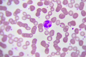 Neutrophil cell (white blood cell) in blood smear, analyze by microscope
