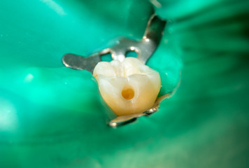 Treatment of one tooth close-up in latex headscarf cofferds dental fillings, hole, cavity, dissection