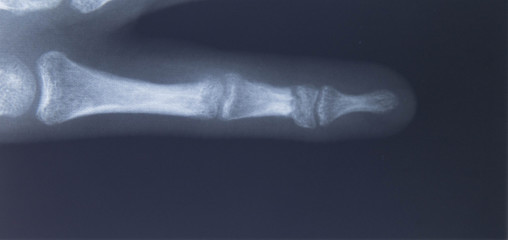 Röntgenbild, kleiner Finger
