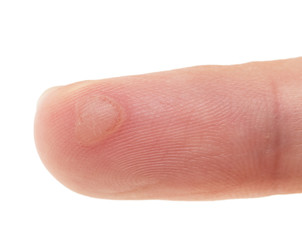 Blister from burn on finger