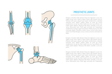 Medical illustration of the implantation of the bone joints in the human skeleton. Layout of implants, artificial joints, in different parts of the human body