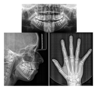 Fernr&ouml;ntgenseitenaufnahme, Orthopantomagramm und Handaufnahme