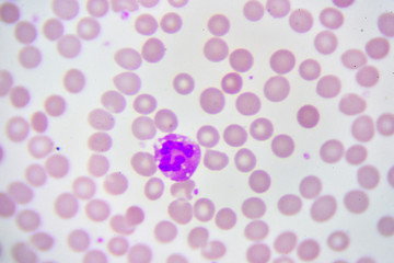 Neutrophil cell (white blood cell) in blood smear, analyze by microscope
