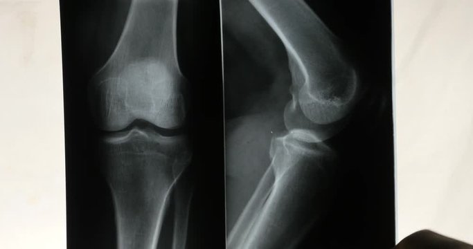 4k doctors study arm,leg joints X-ray film for analysis.medical health hospital.