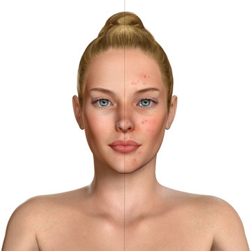 3d illustration of a woman before and after acne treatment procedure
