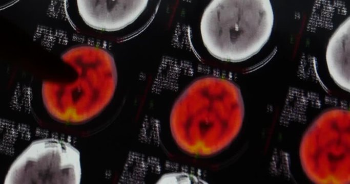 4k Doctor study head pet-ct skull brain scan X-ray film for analysis disease.