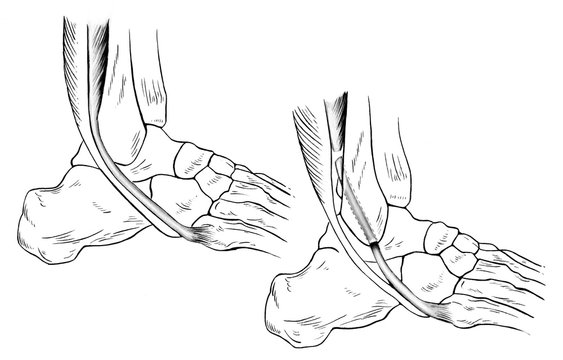 Illustration of a sprained (right) and normal (left) ankle. A torn peroneus brevis tendon is shown pulled forward from its normal position..
