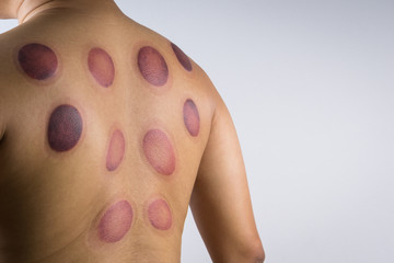 A man back with blood marks massaged © bonnontawat