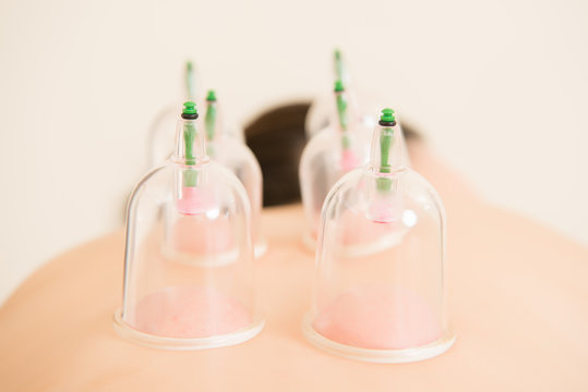 close up picture of cupping treatment