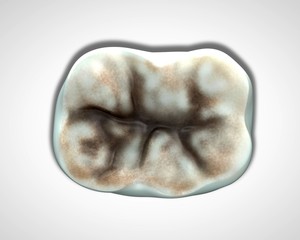 Naklejka premium 3d rendering - decay in molar teeth