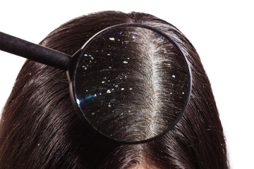 The doctor looks through a magnifying glass at the dandruff on dark female hair