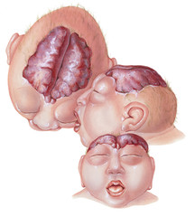 Anencephaly is the absence of a large part of the brain and the skull. Anencephaly occurs early in the development of an unborn baby. It results when the upper part of the neural tube fails to close.