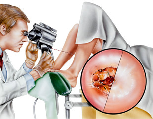 Cervical laser surgery to precisely remove abnormal tissues from the cervix (sparing normal tissue). - obrazy, fototapety, plakaty