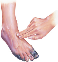 Diabetic arterial disease, showing gangrene and ulcerations of the toes.