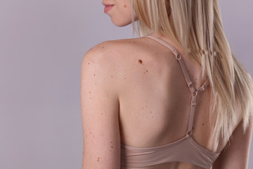 Checking benign moles : Beautifull Woman with birthmarks on her back and face. Laser skin tags...