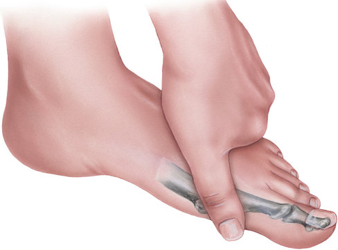 Hand pressing on medial view of foot on metatarsal bone