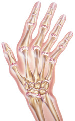 Shown is a hand with severe arthritis of  the joints, This would cause joint seizure and severe pain as well as a great reduction in the range of motion.
