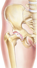 Osteoarthritis is a noninflammatory degenerative joint disease characterized by the breakdown of the joint's cartilage.