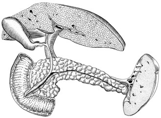 Liver - Cirrhosis. Also shown are the gall bladder, pancreas, spleen, duet to intestines.