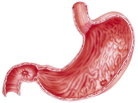 Stomach - with peptic ulcers