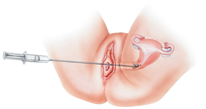 Uterus - Hysterosalpingography (HSG) Test