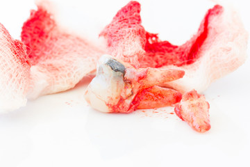 Extraction of decayed tooth with bloody gauze pad on white background. health concept.