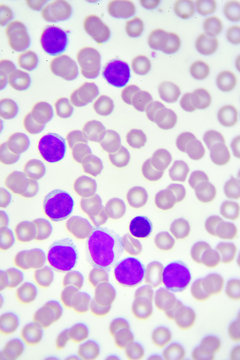 Leukemia cells in blood smear
