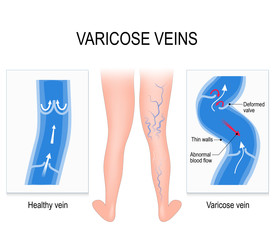 Varicose veins. Medical illustration