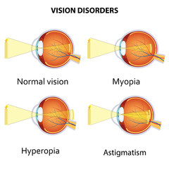 Common vision disorders. - obrazy, fototapety, plakaty