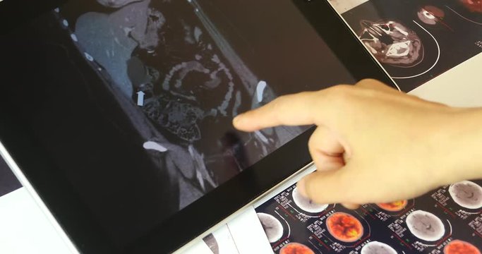 4k Doctor Study Mri Scanner On Ipad,head & Organ Pet-ct,Cancer Metastasis.