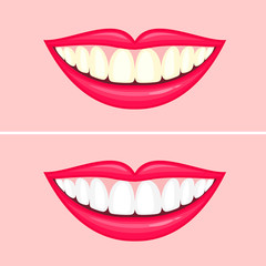 bleaching teeth treatment. Whiten teeth before and after. Vector illustration isolated on pink background. Dental care concept.